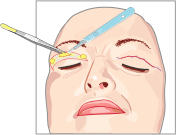 Plastische chirurgie - bovenste ooglidcorrectie